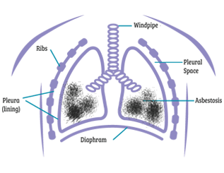 Asbestosis Lung Diagram